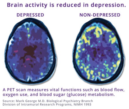 Brain Activity During TMS Therapy